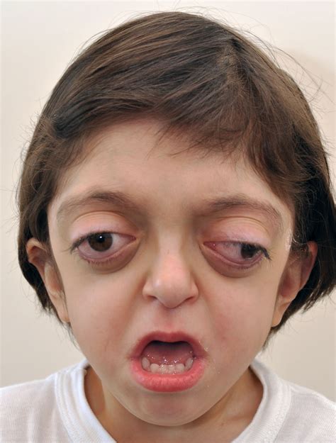 Crouzon Syndrome .
